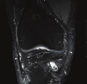PDw SPAIR a-tse PDw SPAIR Interference screw fragments in knee The coronal PD-weighted, asymmetric TSE, SPAIR image clearly visualizes interference screw fragments on a post ACL repair.
