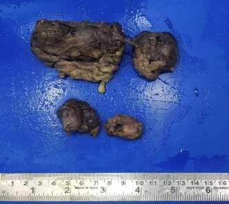 Fig-4: Total thyroidectomy specimen with