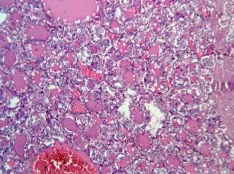 Fig-6: Section from thyroid showing lobules of thyroid acini separated by fibrous septa and