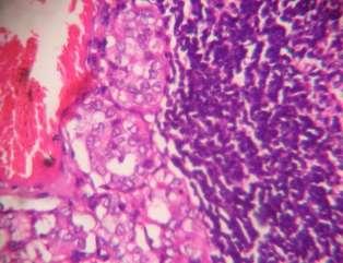 Fig-9: Section of rebits from lymph node showing lymphoid tissue infiltrated by neoplastic thyroid follicular cells (H&E,