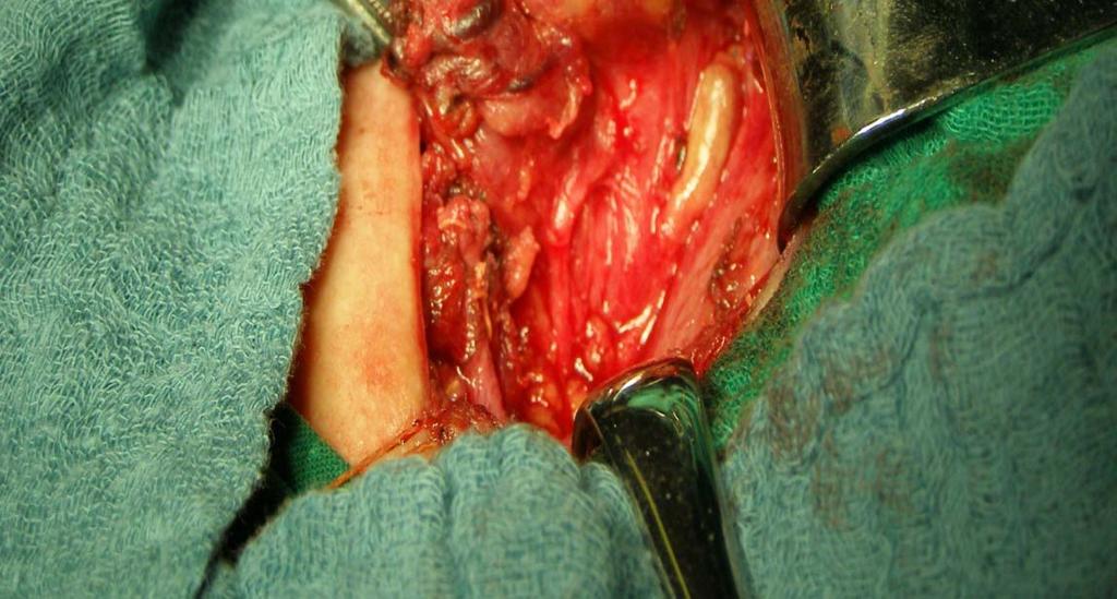 situ with their vascular pedicle.