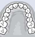 mirrors at rear of terminal molar and