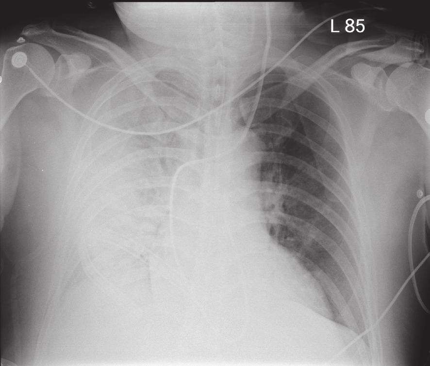 Ling-Chih Hsu et al. Fig. 2. Post-operative chest radiograph demonstrating diffuse, dense opacification on the right pulmonary field, consistent with severe right-sided pulmonary edema.