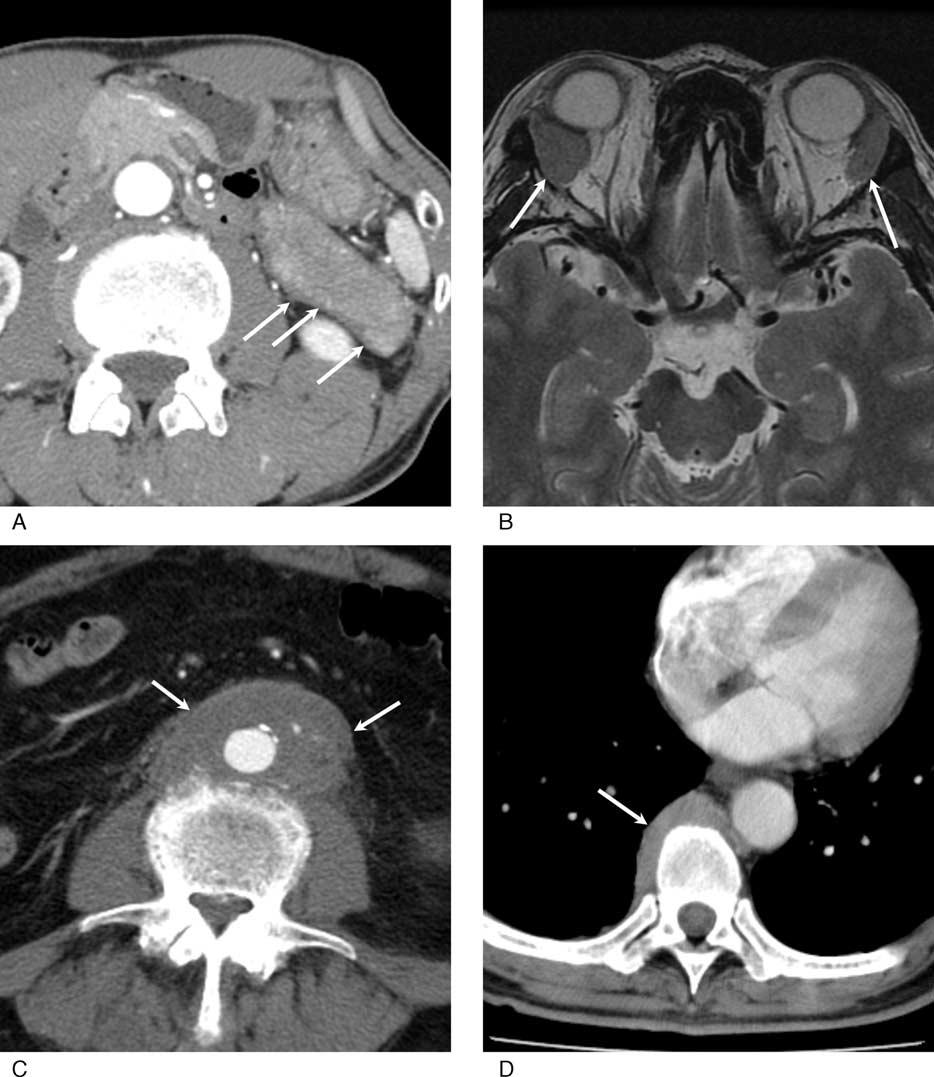 Medicine Volume 9, Number 15, April 215 IgG-Related Disease FIGURE 1. Radiological features of IgG-RD. (A) Contrast-enhanced CT.