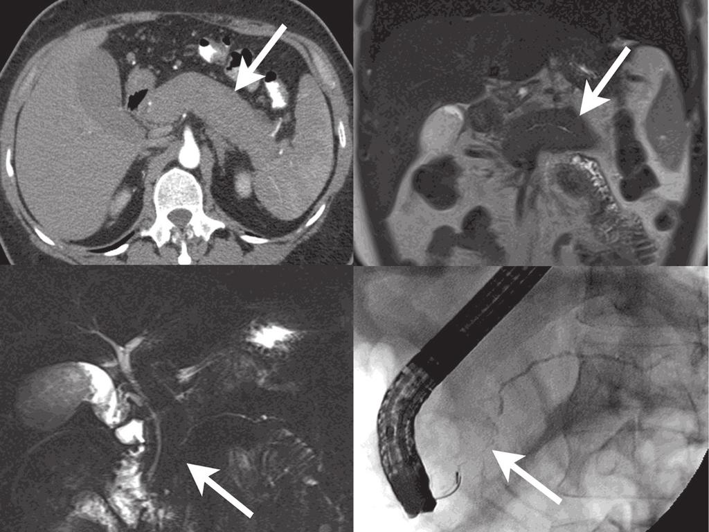 Patel et al. BMC Gastroenterology 2013, 13:168 Page 3 of 9 A B C D Figure 1 Diffuse autoimmune pancreatitis. A. Axial CT image in the pancreatic parenchymal phase shows the typical enlarged, poorly enhancing gland (arrow).