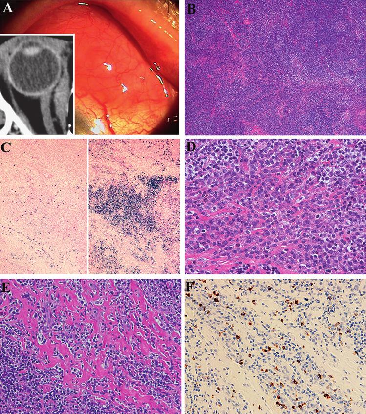 Figure 3 Findings in a 67-year-old man with bilateral conjunctival marginal zone B cell lymphoma without IgG4-positive plasma cells.
