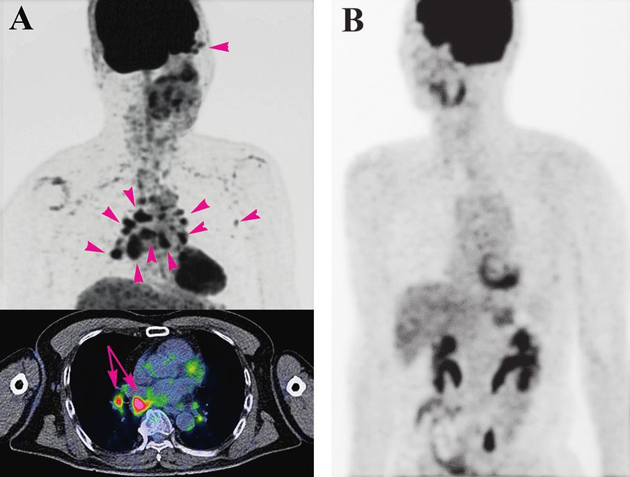 Figure 5 Fluorodeoxyglucose F-18 (FDG) positron emission tomography at the initial examination of patient 6 (A) whose ocular data are presented in figure 3 (B).
