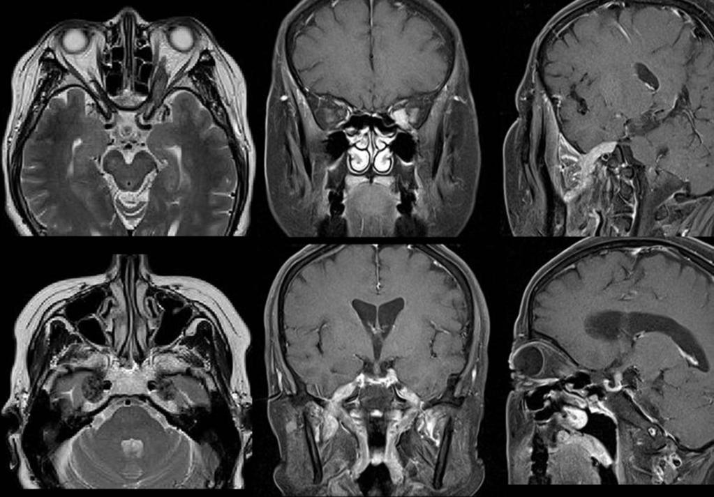 Fig. 1: MRI shows soft-tissue mass involving the skull base along with