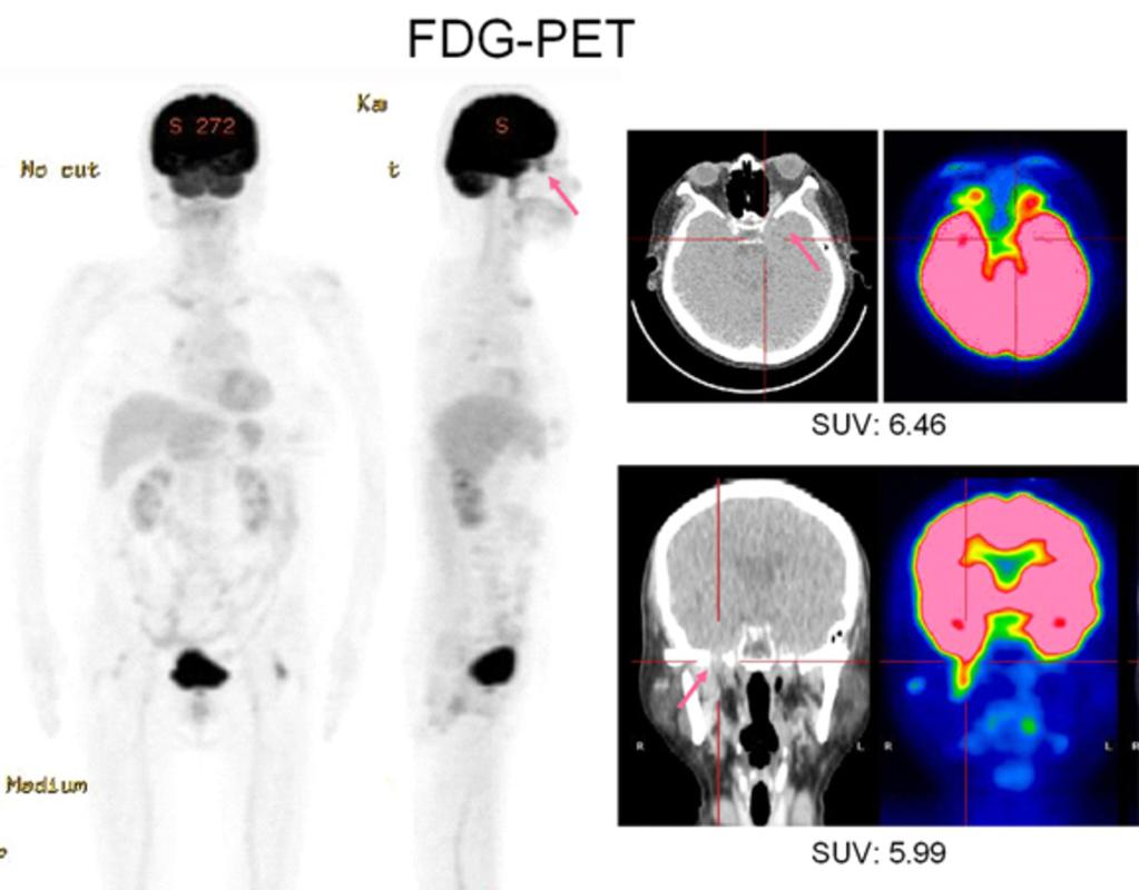 Fig. 2: PET-CT reveals moderate FDG