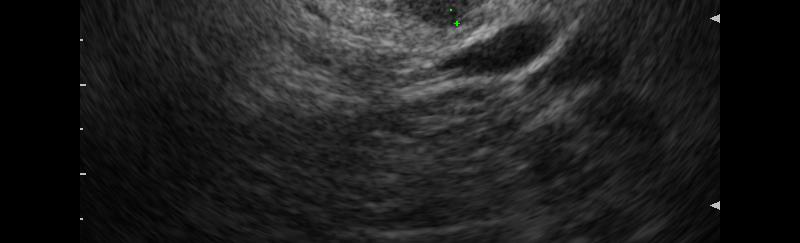 EUS September 2010 Nodule Metachronous PDAC in Region Separate from the Index Cyst