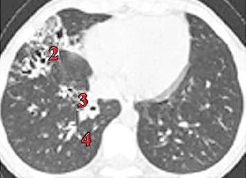 Mucus-plugged bronchus Can visualize structure and function of the lungs and other organs 3 Does not use radiation 3,4 Emerging MRI techniques used in research include: Ventilation MRI of the lungs