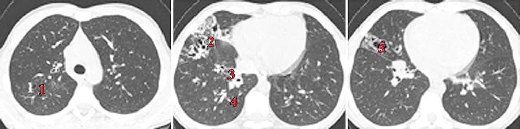 Patients with CF may experience structural lung damage before ppfev 1 declines HRCT scans with lung abnormalities in a 13-year-old with a ppfev 1 of 99% 1 1. Bronchiectasis 2. Peripheral cysts 5.