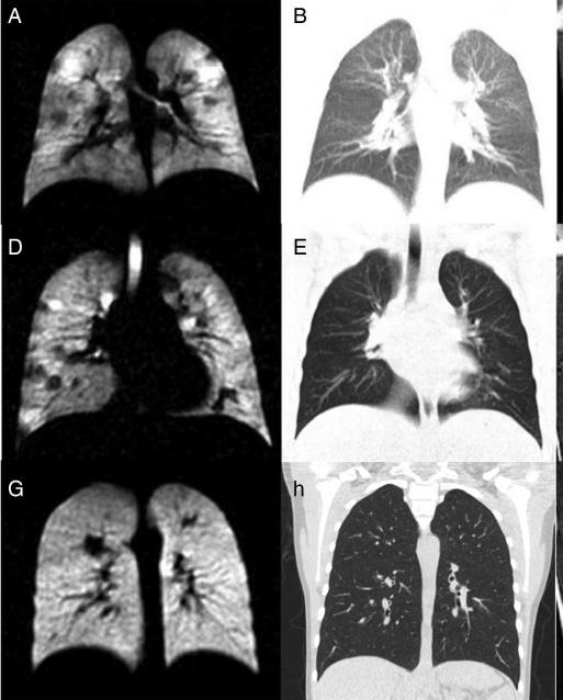 Lung disease may also be detected by MRI The use of MRI in CF continues to evolve Historically, MRI has been of limited use in assessing lung disease 1 New MRI research techniques, such as