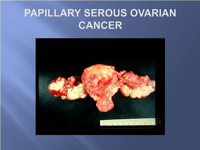 Symptoms Women with ovarian cancer report Symptoms that are persistent Represent a change from normal for their bodies On average lasting for approximately six months to one year in many instances