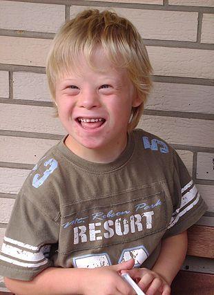 Genetic Disorders Down Syndrome Caused by the presence of all or part of a third copy of chromosome 21 It is