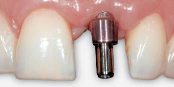 Whether you re working in the supragingival or subgingival region, it s suitable for all