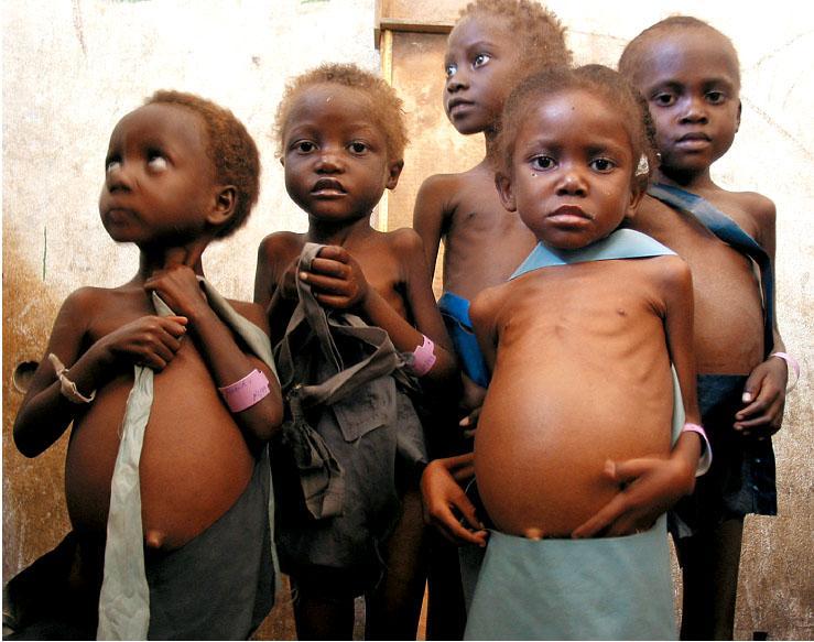 Kwashiorkor (KWASH-ee-OR-cor) Severe dietary protein deficiency reduces the protein content of the blood plasma and