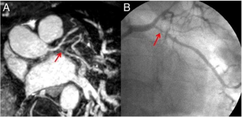 060 Images in a 81-Year-Old Male Patient With Multiple Risk Factors (A) Thin-slab maximum intensity projection image and (B) conventional angiogram show significant stenosis (red arrow) in the