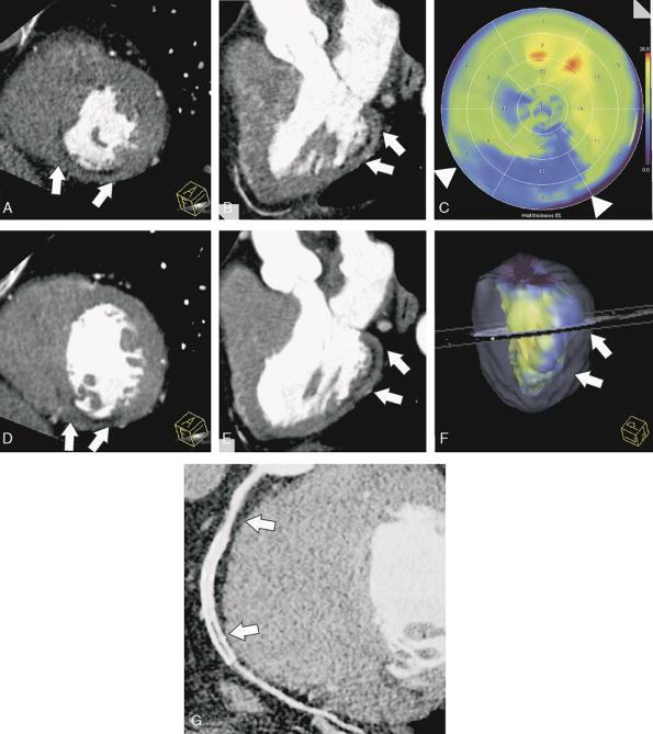 Integrative Computed Tomography Imaging of Ischemic Heart Disease. Ruzsics, Balazs; MD, PhD Journal of Thoracic Imaging. 25(3):231-238, August 2010. DOI: 10.1097/RTI.0b013e3181dc2a1f FIGURE 1.