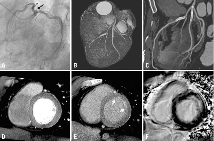 Integrative Computed Tomography Imaging of Ischemic Heart Disease. Ruzsics, Balazs; MD, PhD Journal of Thoracic Imaging. 25(3):231-238, August 2010. DOI: 10.1097/RTI.0b013e3181dc2a1f FIGURE 4.