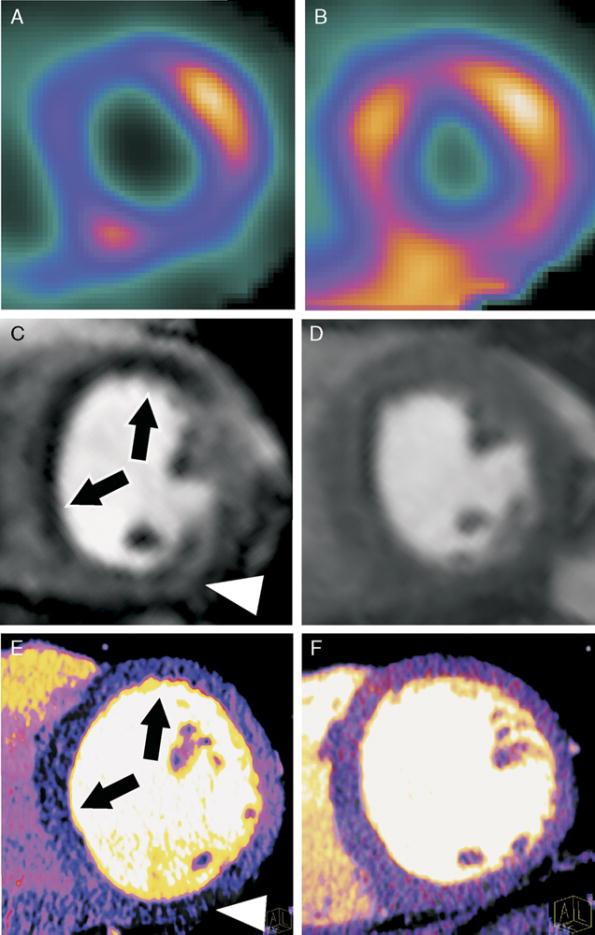 SPECT examination as standard functional imaging modality at stress (A) and rest (B) revealed the presence of stress-induced reversible ischemia in the anterolateral wall.