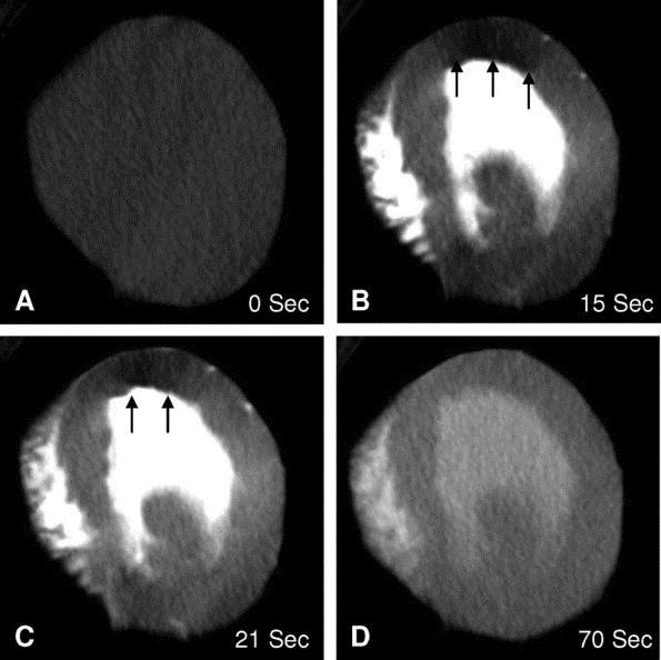 2 FIGURE 6. Adenosine stress dynamic multidetector computed tomography (d- MDCT) imaging of the mid left ventricle in a canine model of left-anterior descending artery stenosis.