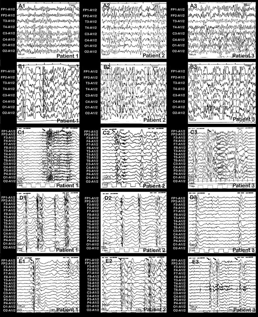 S. Buoni et al. / Clinical Neurophysiology 117 (2006) 223 227 225 Fig. 1. EEGs from patients 1, 2, and 3. Note the presence of the several patterns characterizing the early myoclonic encephalopathy.