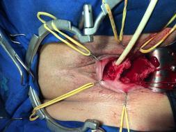 basis: pubourethral ligaments Anatomical