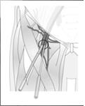 ECMO) Generally Femoral vein to Femoral