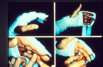 Protected Tenodesis Modified Kleinert Dorsal blocking orthosis Wrist in 45 flexion MPs 40 flexion IPs allowed full extension Volarly applied PFT (postoperative