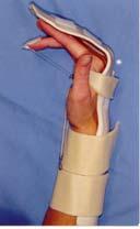 distal palmar crease, and on the forearm strap Zone 1 LEAF protocol Limited extension active flexion (LEAF) Evans, 1990 Rationale: Place the repaired FDP tendon in a