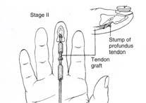 STAGE II Active tendon graft is used Surgeons preferred tendon protocol Usually 3 6 months after stage I References Culditz, Judy Protecting Flexor Tendon Repairs Clinical Pearls No.