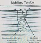 Tendon Healing Extrinsic Healing Adhesion formation between tendon and surrounding tissue Potenza and Peacock (1960 70's) Tendons healed by fibroblastic response (adhesions) Tendon cells were