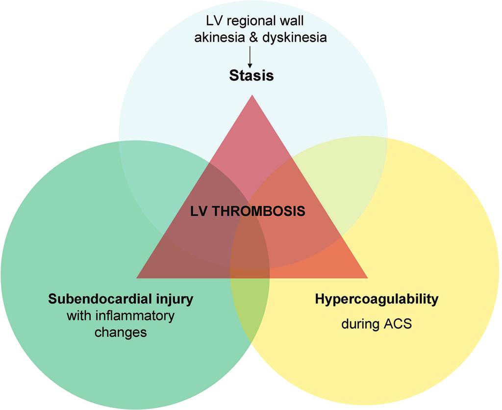 Figure 1 The three components of the Virchow s triad in left ventricular thrombus formation. ACS, acute coronary syndrome; LV, left ventricular.