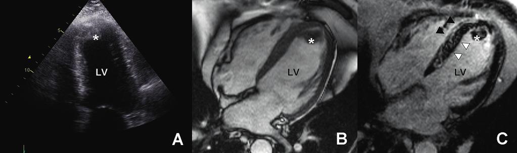 Education in Heart Figure 2 Left ventricular (LV) thrombus formation on delayed gadolinium contrast cardiac MRI and transthoracic echocardiography.