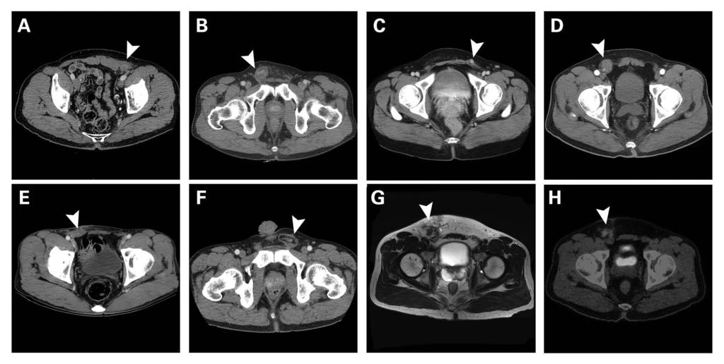 RESEARCH Fig. 3: Image findings of patients with inguinoscrotal liposarcoma. A) Patient 7 had a 4.5 cm mass in the inguinal canal. B) Patient 8 had a 4 cm mass in the inguinoscrotal region.