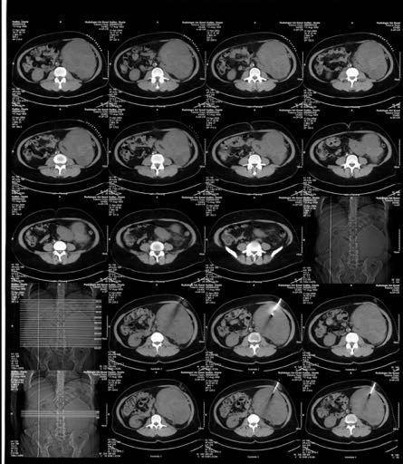 Imaging in Retroperitoneal Sarcoma CT-guided Core