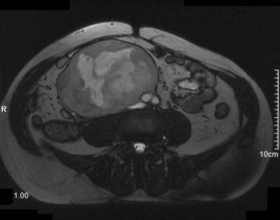 Surgical Planning in Retroperitoneal Sarcoma