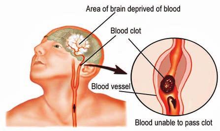 Stroke can cause muscle weakness difficulty with: speech and communication; vision; Mini stroke thinking and planning.