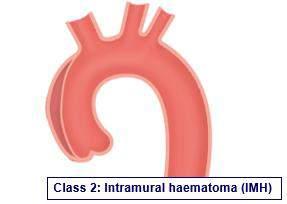 Intramural Hematoma (IMH) Hematoma develops in the media of the aortic wall in the absence of a false lumen or intimal tear.