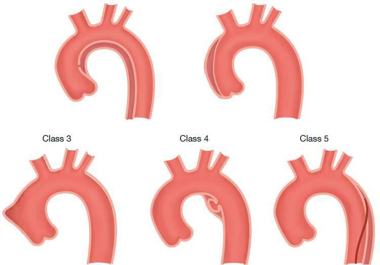 Class 1: Classic AD Class 2: Intramural haematoma (IMH) Classification of Acute Aortic Syndromes (AAS) According to Pathophysiology Class 3: Subtle or discrete AD
