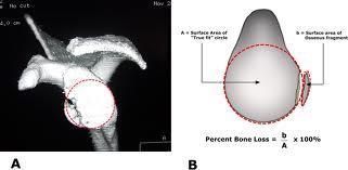 bone defect and also to assess Hill Sach