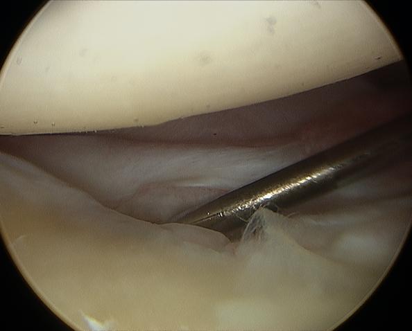 Glenoid Humeral head Anterior capsule Labrum