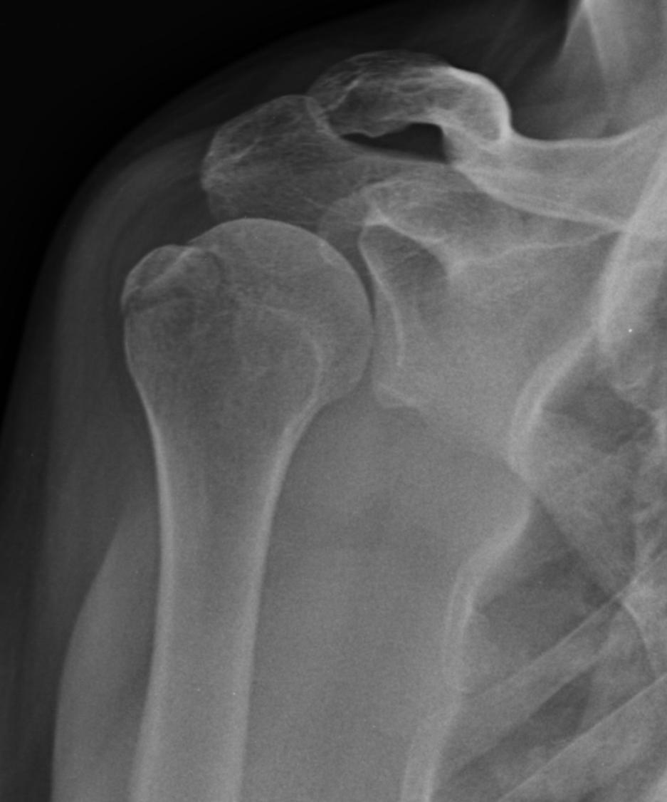 Greater tuberosity fractures Indications for Greater tuberosity fractures > 2 mm Isolated axillary nerve injury Subacromial impingement (common)- due to displacement of fragment or even scar