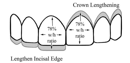 Using ICW & CIH to determine size of maxillary anterior teeth(ward) Calculating RED & Individual tooth widths from ICW& CIH ICW/CIH RED Central Incisor Width Lateral Incisor Width Canine Width 3.