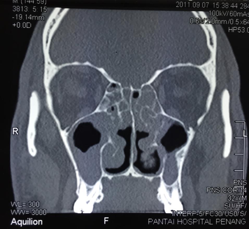 Mr YTW, 32 Male Chinese, Presented in 2011 with Recurrent Bilateral