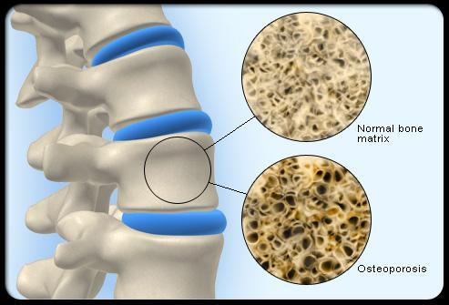 Clastic activity is the opposite where the cells lead to breakdown, metabolism or decrease bone formation or the term also applies to the activity of osteoclasts which increase bone resorption.