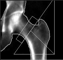This amount of internal rotation presents the long axis of the femoral neck perpendicular to the X-ray beam, providing the greatest area and the lowest bone