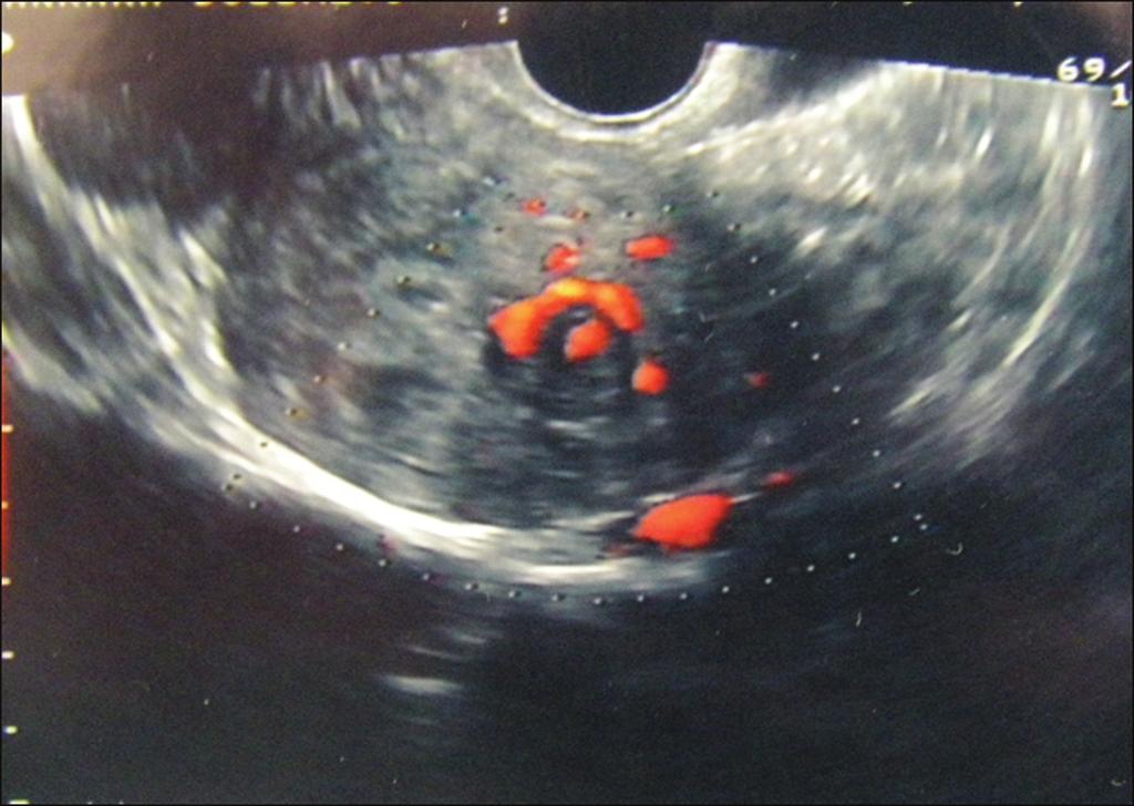 characteristic of submucosal fibroid. Statistical analysis The Shapiro Wilks test was used to assess the distribution of continuous data.