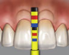 The BLPG tip is used to achieve the proper clinical and biologic crown length during surgical crown lengthening